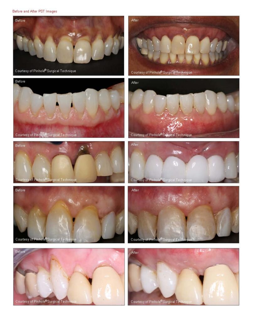 Before and after Pinhole Gum Therapy in Round Rock TX