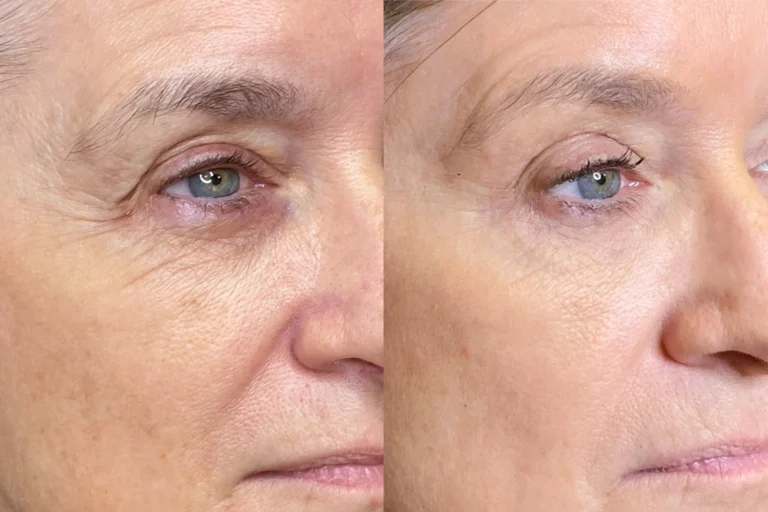 Procell before and after 1