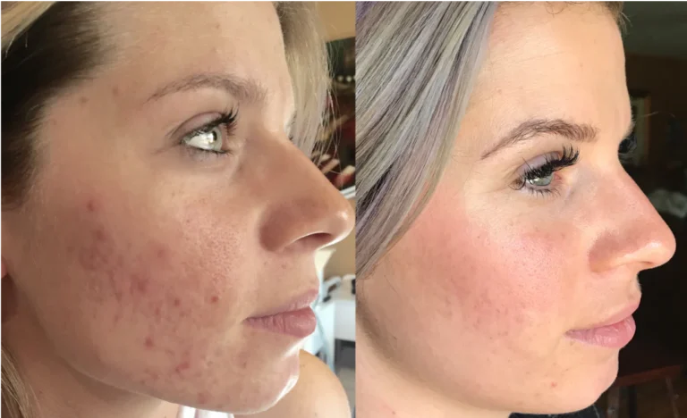 Procell before and after 2