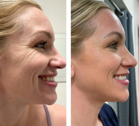 Procell before and after