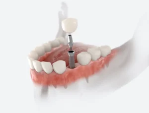 Why Dental Implants Are the Gold Standard in Round Rock, TX